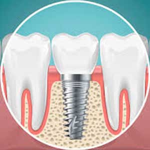 Dental Implants in Nallagandla