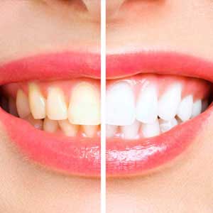 Teeth Whitening in madinaguda